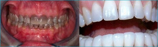 Một vài trường hợp điều trị răng sậm màu do nhiễm Tetracycline với răng toàn sứ Zirconia