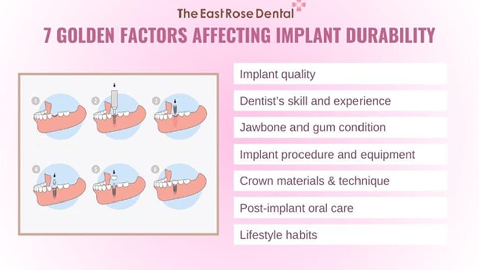 7 Key Factors That Determine the Longevity of Dental Implants