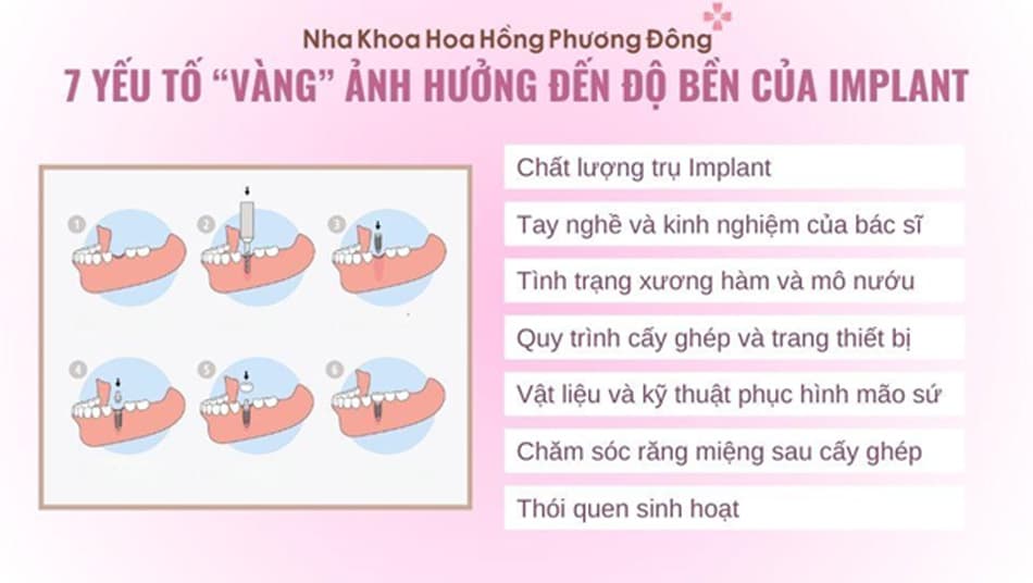 7 Yếu tố quyết định độ bền khi trồng răng Implant