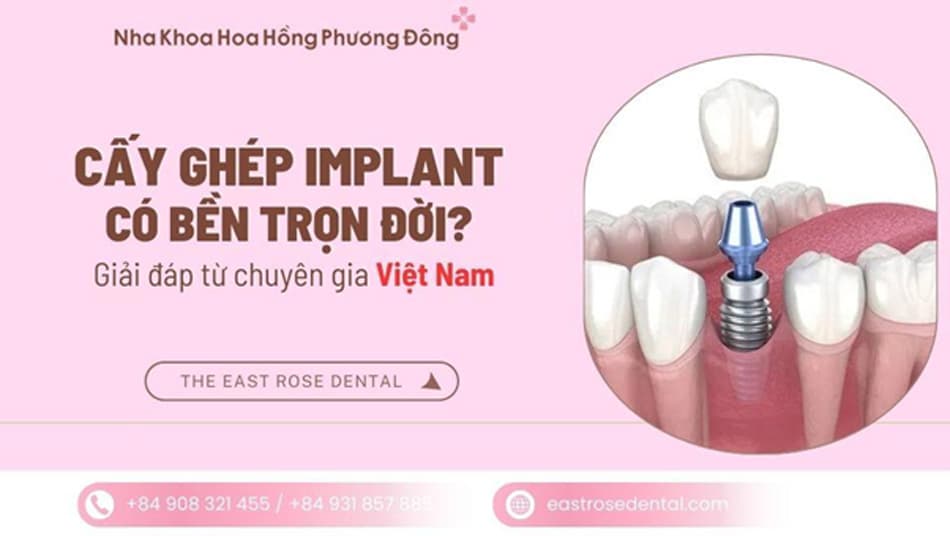 Cấy ghép Implant có bền trọn đời không? Giải đáp từ y khoa