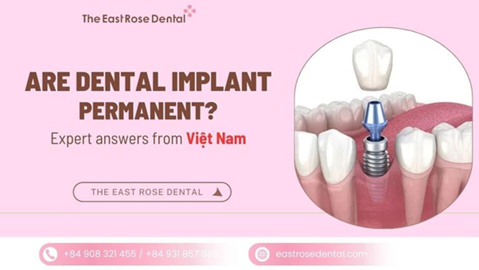 Can Dental Implants Really Last a Lifetime? A Medical Perspective