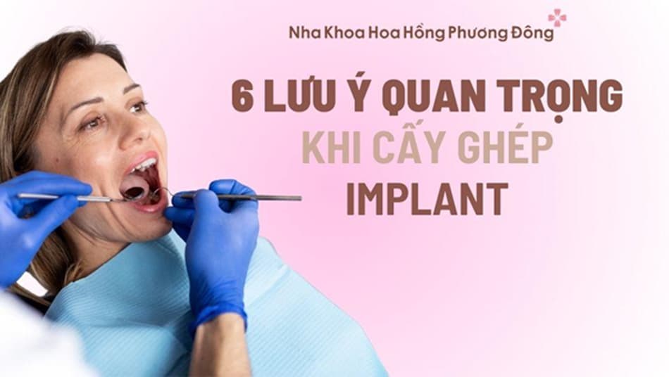 Một số lưu ý quan trọng khi cấy ghép Implant
