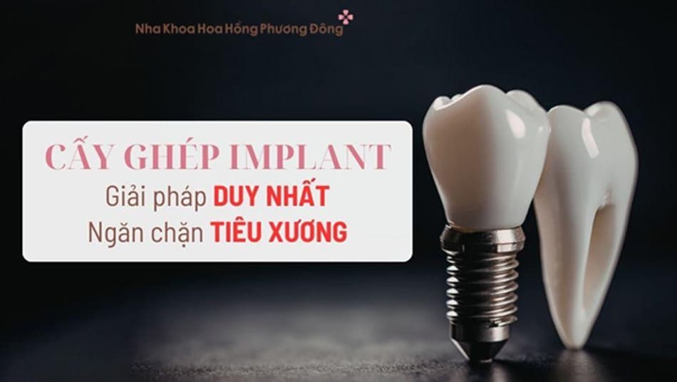 Cấy ghép Implant là giải pháp duy nhất giúp ngăn ngừa tiêu xương