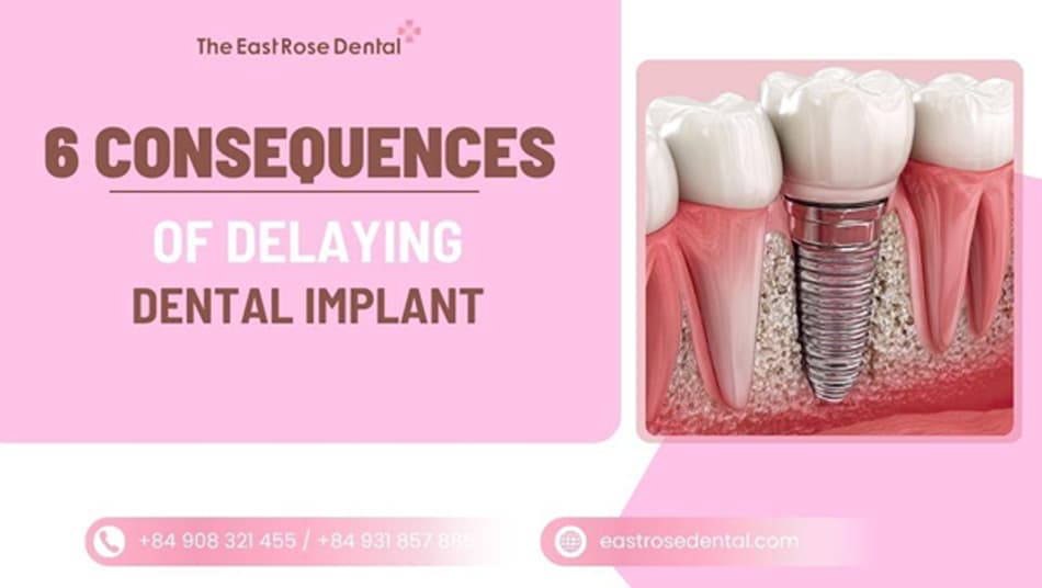 Delaying Dental Implants: A Serious Warning About Progressive Jawbone Loss