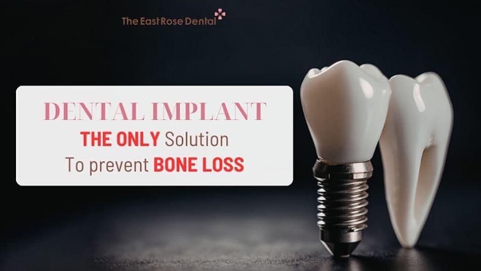 Dental implants are the only solution that prevents jawbone loss