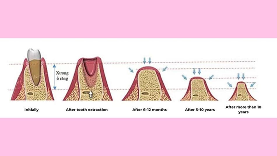 Dental implants should be placed within 3–6 months after tooth loss