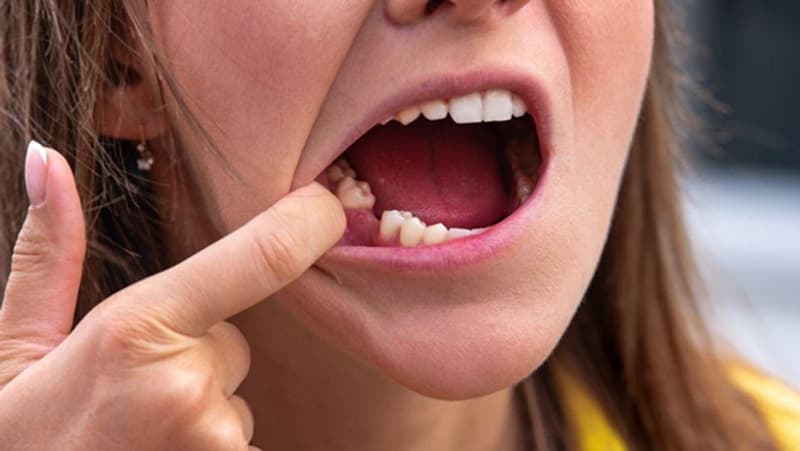 Mất răng khiến vi khuẩn tích tụ gây nên các bệnh lý như viêm nha chu, viêm nướu