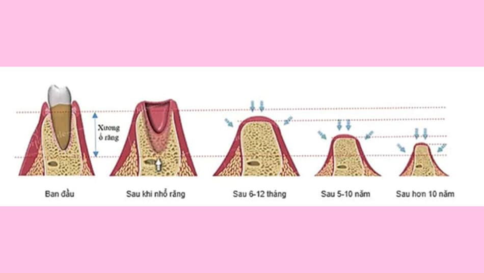 Nên cấy ghép Implant trong 3 đến 6 tháng sau khi mất răng