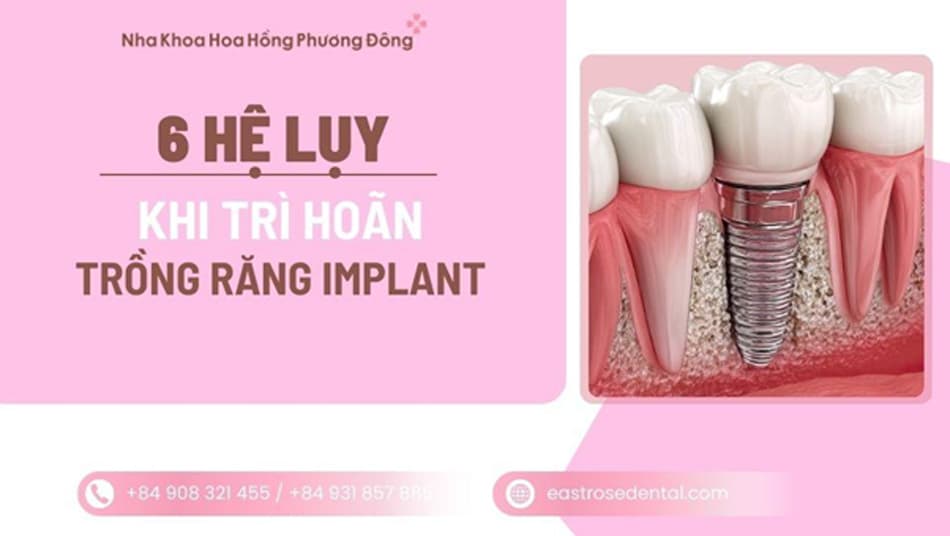 Trì hoãn trồng răng Implant: Cảnh báo hệ lụy tiêu xương hàm nghiêm trọng