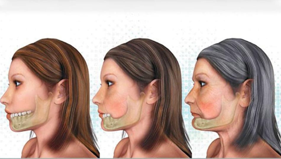 Trì hoãn trồng răng Implant làm xương hàm tiêu biến khiến gương mặt già đi