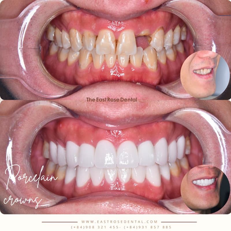 Khách hàng trồng răng Implant và răng sứ tại Nha Khoa Hoa Hồng Phương Đông