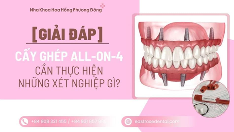 Trước khi làm Implant All-on-4/6 toàn hàm cần xét nghiệm gì?