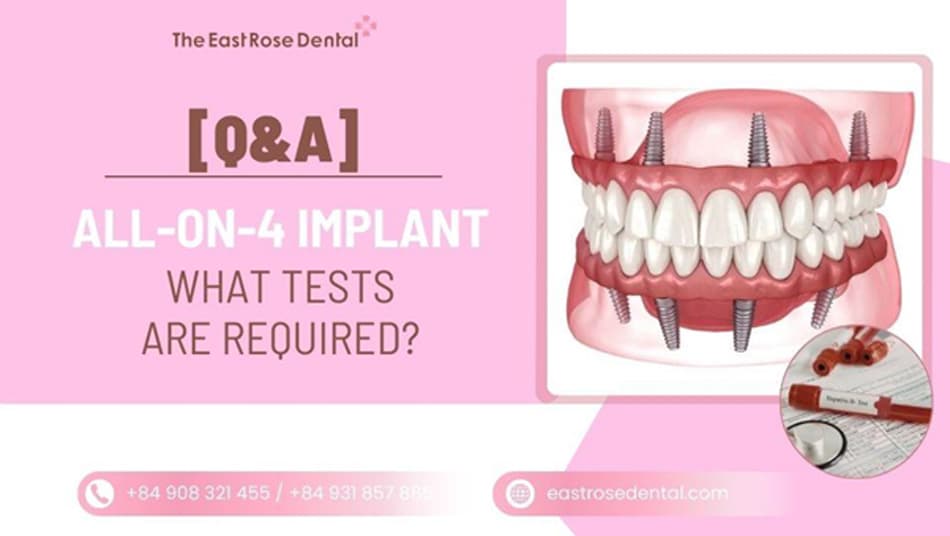 [Q&A] What Tests Are Required Before Full-Arch All-on-4/6 Implants?