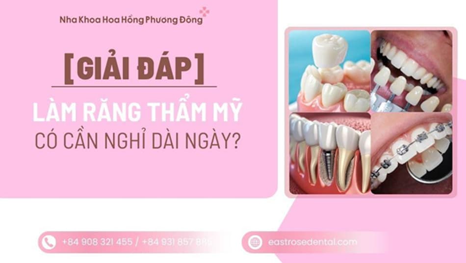 Làm răng thẩm mỹ có cần nghỉ dưỡng dài ngày không?