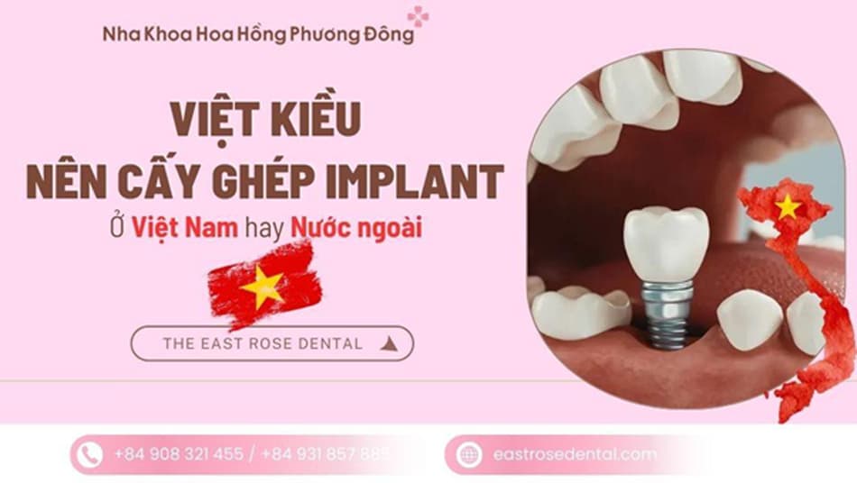 Việt kiều nên trồng răng Implant tại Việt Nam hay nước ngoài?