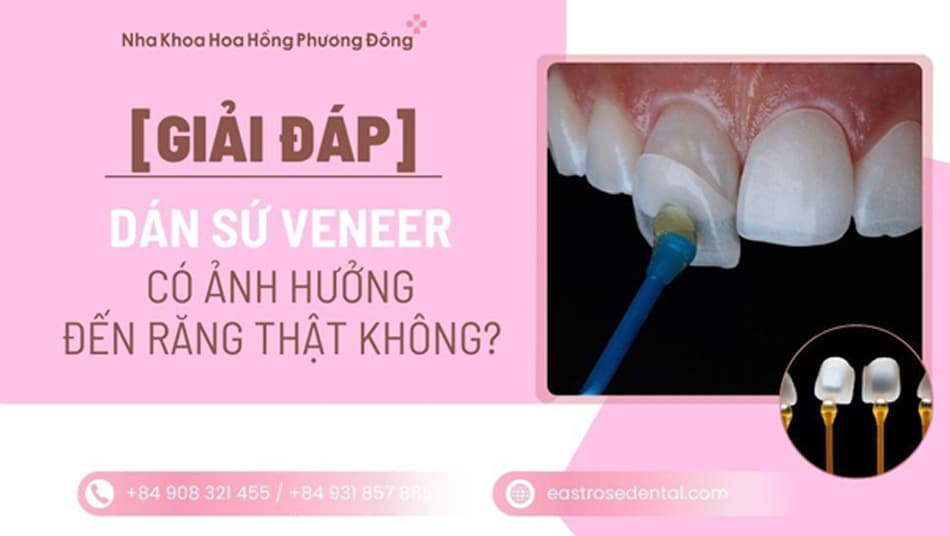  Dán sứ Veneer có ảnh hưởng răng thật không? Giải đáp từ chuyên gia