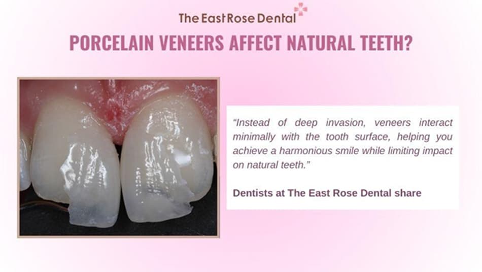 Do Veneers Affect Natural Teeth?