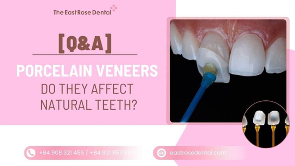 Do Veneers Damage Natural Teeth? Expert Answers