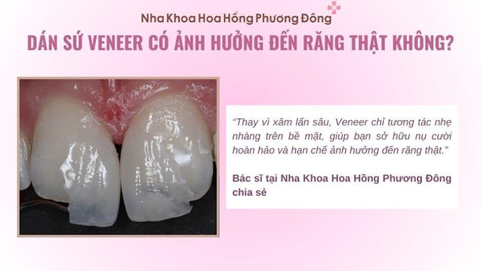 Răng sứ Veneer là phương pháp bảo tồn răng thật tối ưu nhất hiện nay