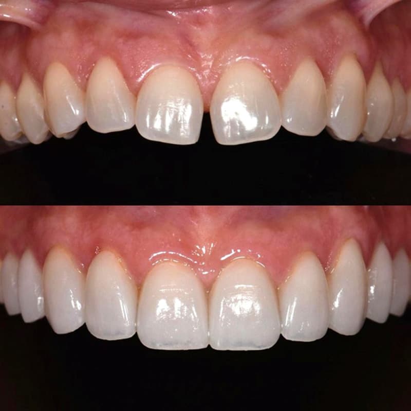 Kết quả dán sứ Veneer thẩm mỹ tại Nha Khoa Hoa Hồng Phương Đông