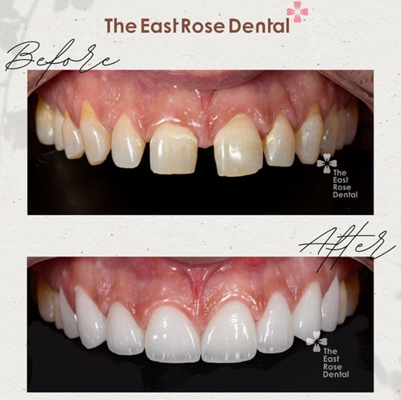 Kết quả dán sứ Veneer thẩm mỹ tại Nha Khoa Hoa Hồng Phương Đông