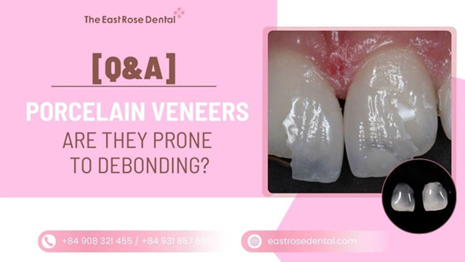 Is Veneer Durable? 4 Mistakes That Cause Porcelain Crowns to Detach