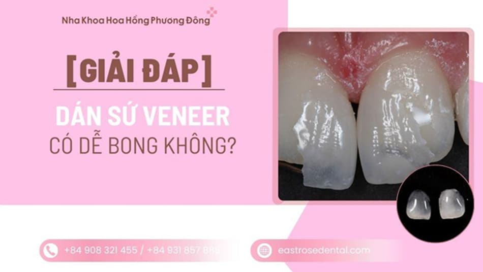 Sự thật dán sứ Veneer có bền không? 4 sai lầm khiến răng sứ dễ bong
