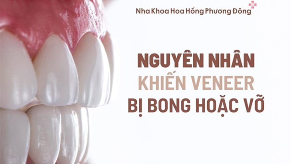 Một số thói quen khiến mặt dán sứ Veneer dễ bong sau khi dán