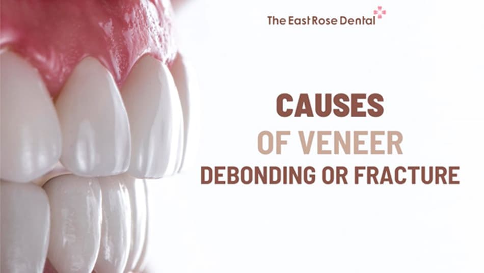 Some habits that make veneers more likely to detach after placement
