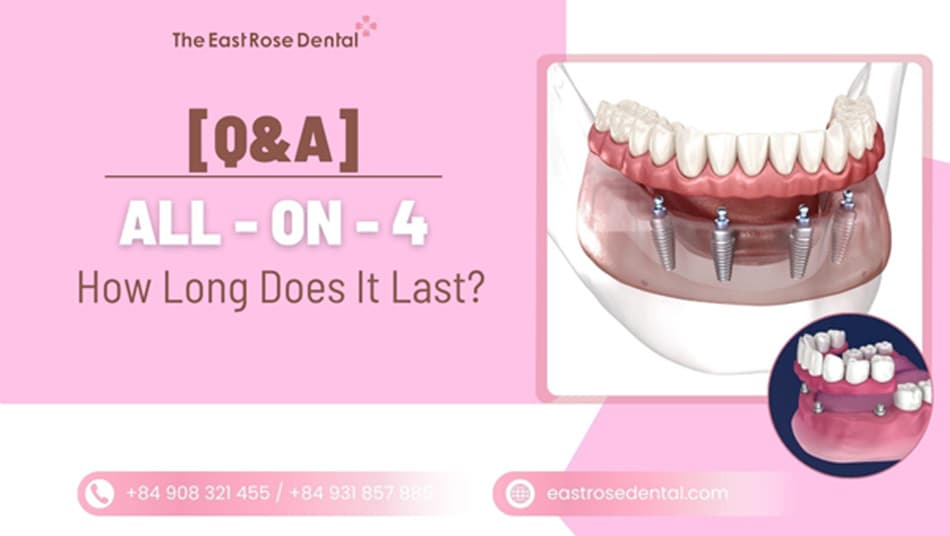 How Long Do All-on-4 Dental Implants Last? Are They Permanent?