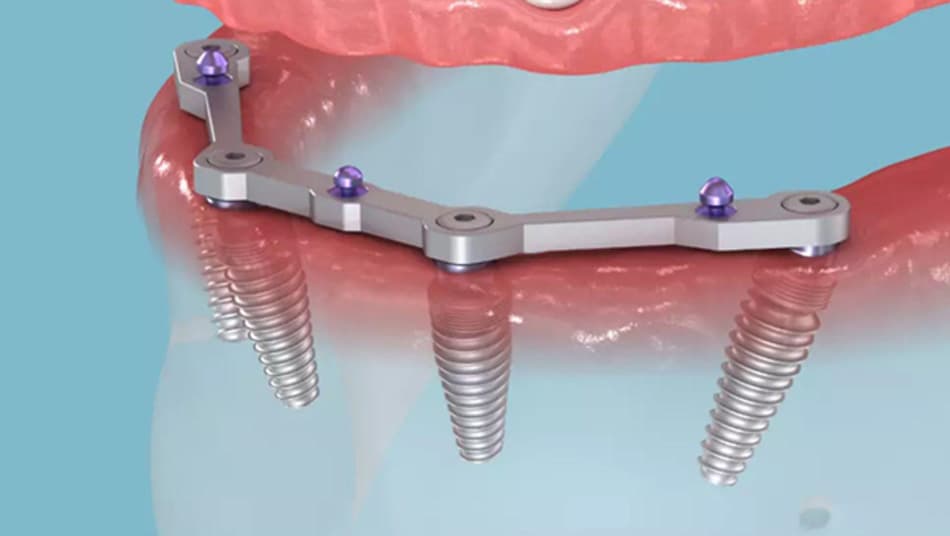 Phần trụ Implant có tuổi thọ trên 20 năm hoặc trọn đời