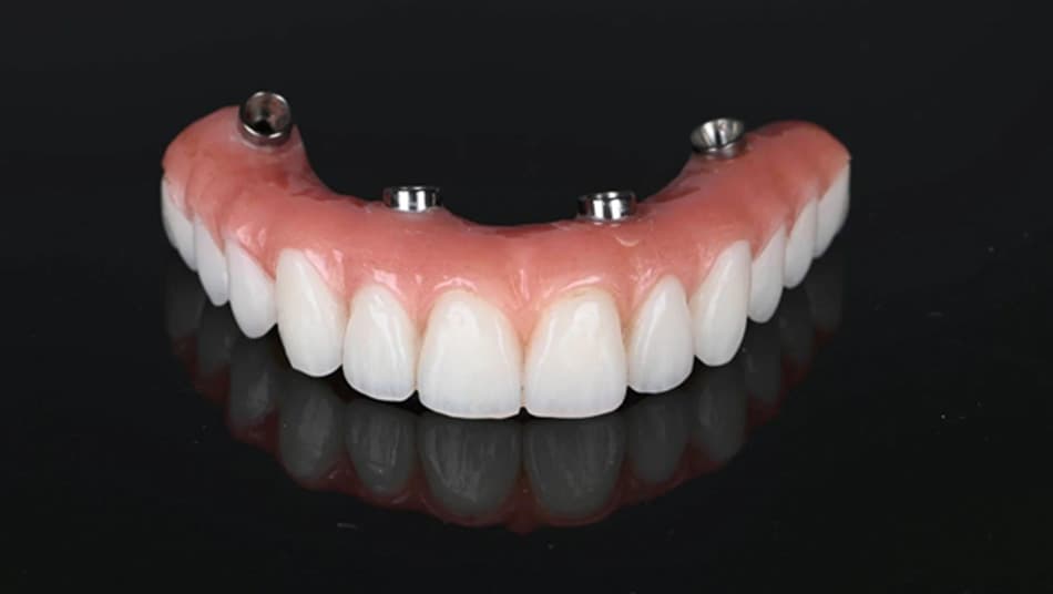 The prosthetic arch typically lasts 10-15 years