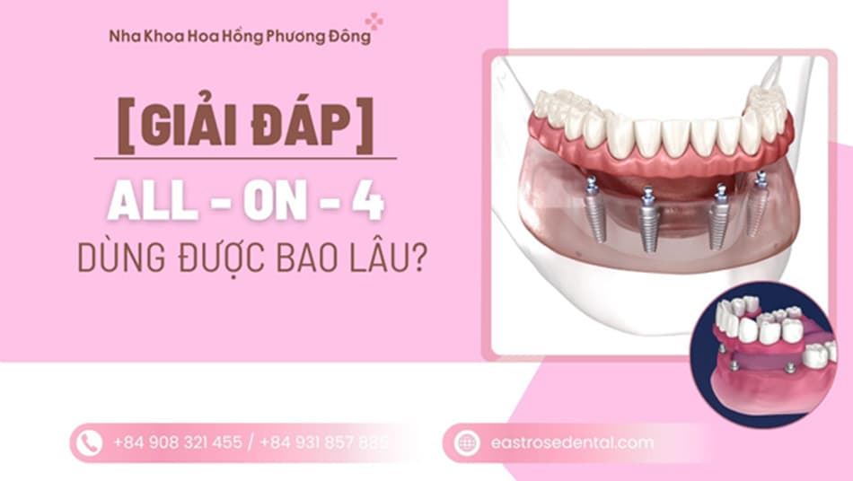 Trồng răng Implant All-on-4 dùng được bao lâu? Có bền trọn đời không?