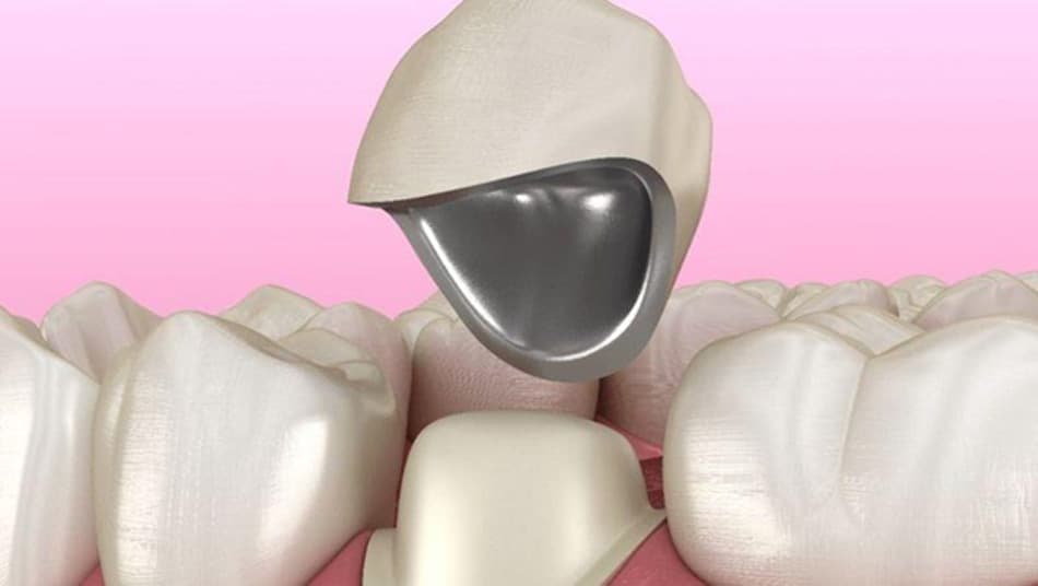 Metal-based crowns are prone to oxidation in the oral environment