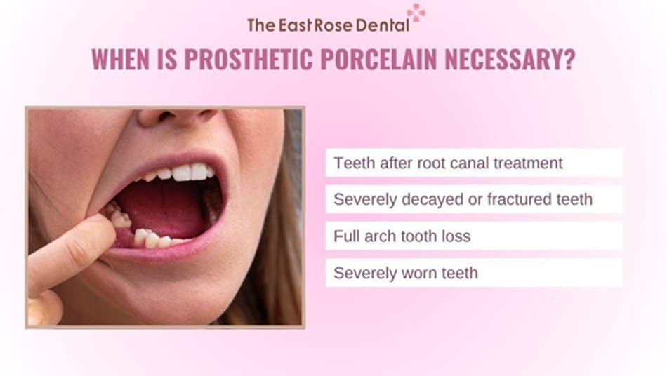 Choose prosthetic crowns if your teeth are structurally damaged
