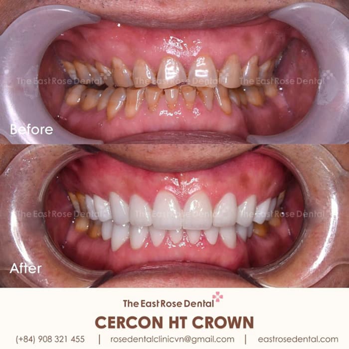 Phục hình răng sứ bị mòn nặng tại Nha Khoa Hoa Hồng Phương Đông