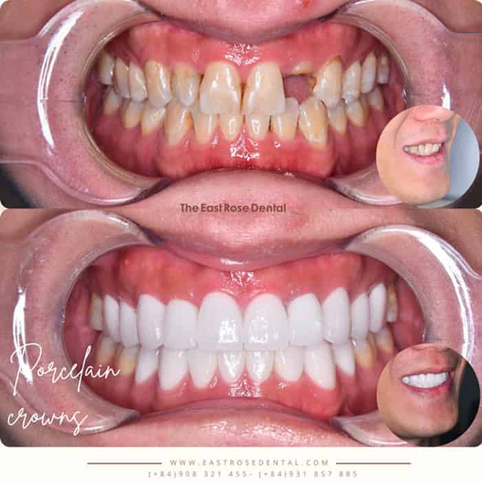Răng sứ phục hình răng tại Nha Khoa Hoa Hồng Phương Đông
