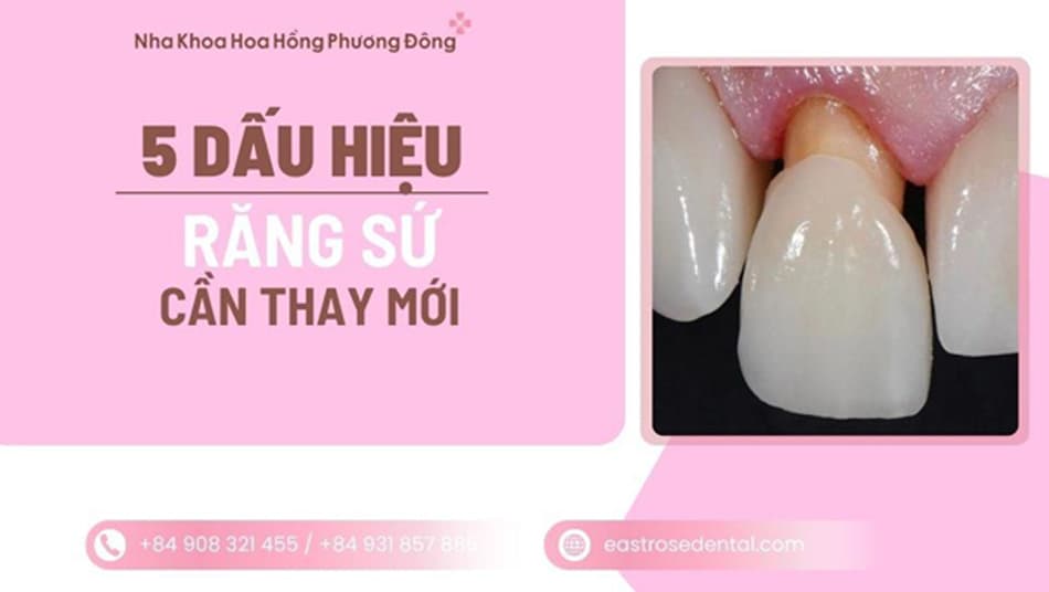 Răng sứ có cần thay không? 5 dấu hiệu nên làm lại răng sứ cũ