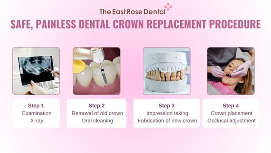Crown Replacement Process at The East Rose Dental