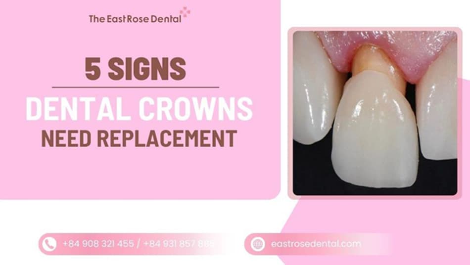 Do Porcelain Crowns Need Replacement? 5 Signs It’s Time to Redo Old Crowns