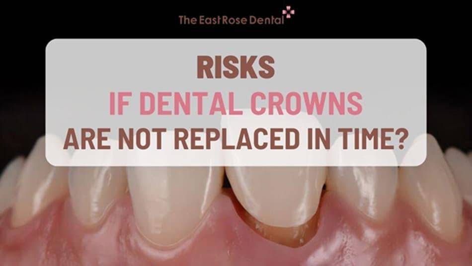 Problematic crowns should be replaced early to protect long-term oral health