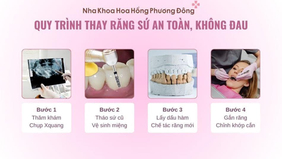 Quy trình thay răng sứ tại Nha Khoa Hoa Hồng Phương Đông