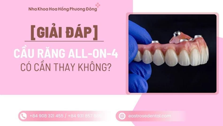 All-on-4 có cần thay cầu răng không? Sự thật về giai đoạn nâng cấp
