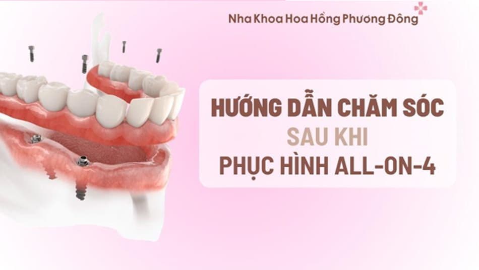 Chăm sóc sau khi cấy ghép All-on-4 giúp duy trì vẻ đẹp và giữ độ bền