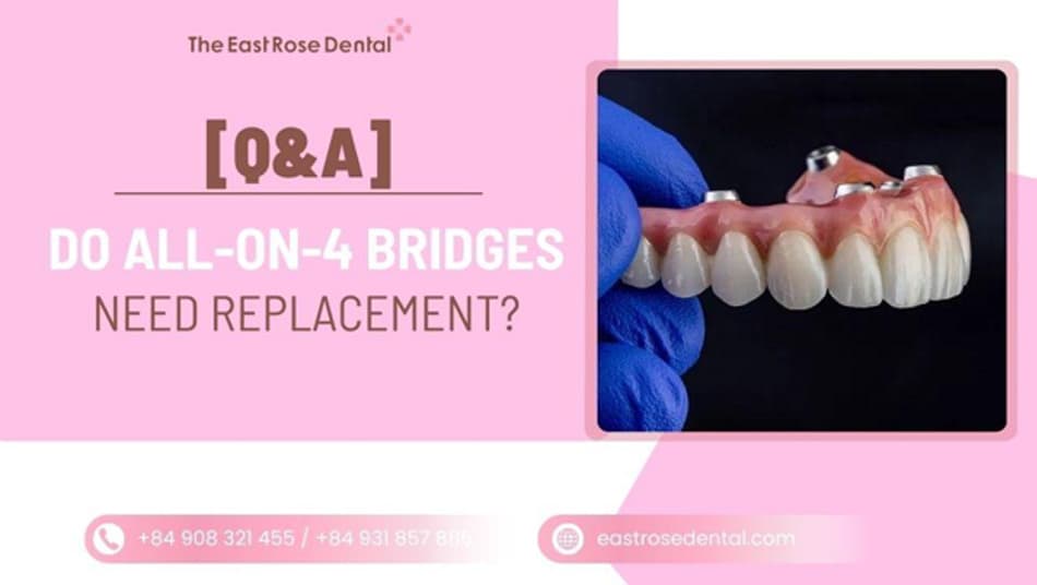 Does All-on-4 Require Bridge Replacement? What You Should Know 