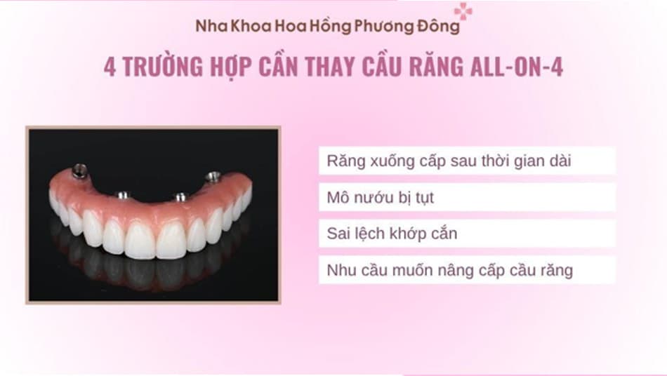 Một số trường hợp cần thay cầu răng All-on-4 sau một thời gian sử dụng
