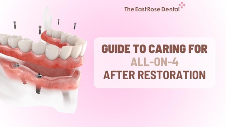 Proper All-on-4 Care Helps Maintain Long-Term Aesthetics and Durability
