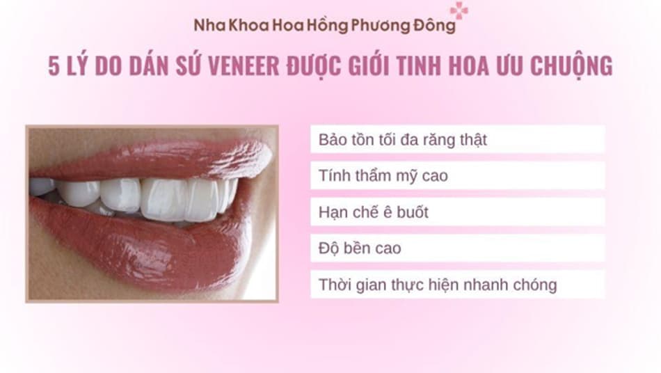 Dán sứ Veneer là sự lựa chọn ưu tiên hàng đầu của giới tinh hoa