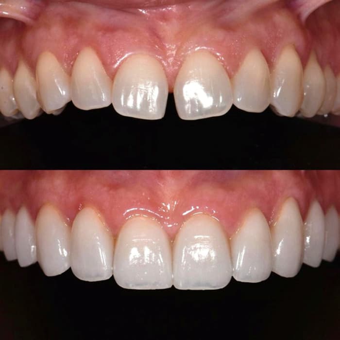 Aesthetic porcelain Veneer results at The East Rose Dental 