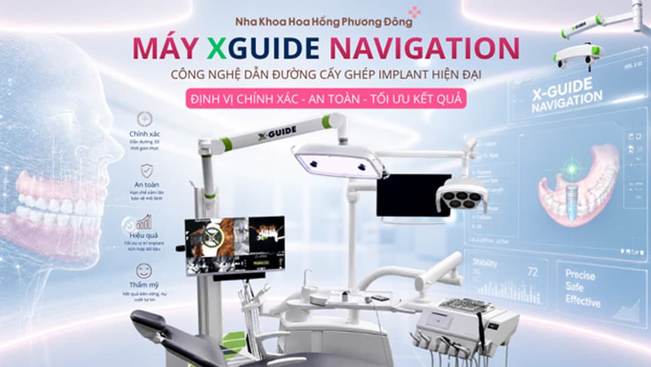 Công nghệ X-guide Navigation trong phẫu thuật Implant: Bước tiến mới của nha khoa hiện đại